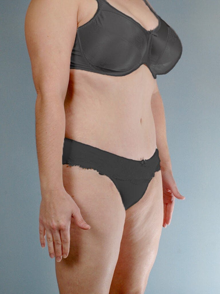 Tummy Tuck Before & After Gallery - Patient 263289 - Image 4