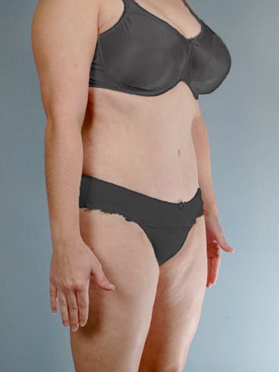 Tummy Tuck Before & After Gallery - Patient 263289 - Image 4