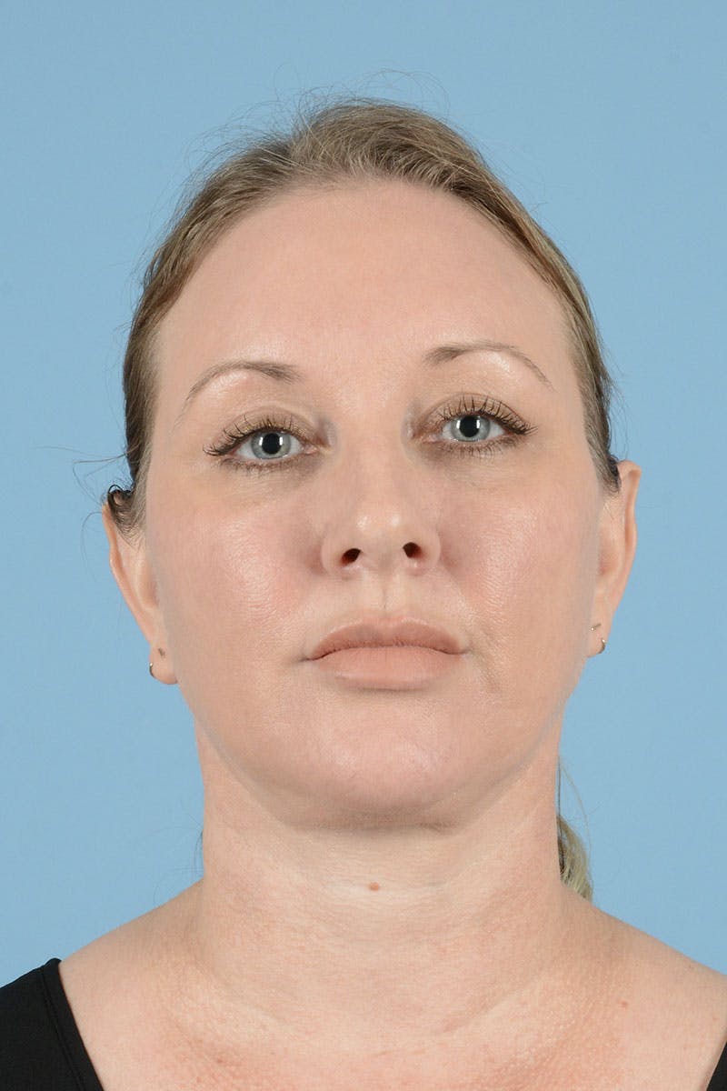 Facelift Before & After Gallery - Patient 443008 - Image 2