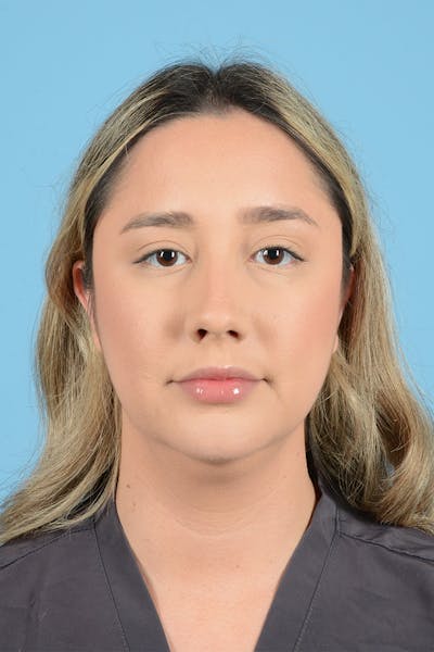 Rhinoplasty Before & After Gallery - Patient 189231 - Image 1