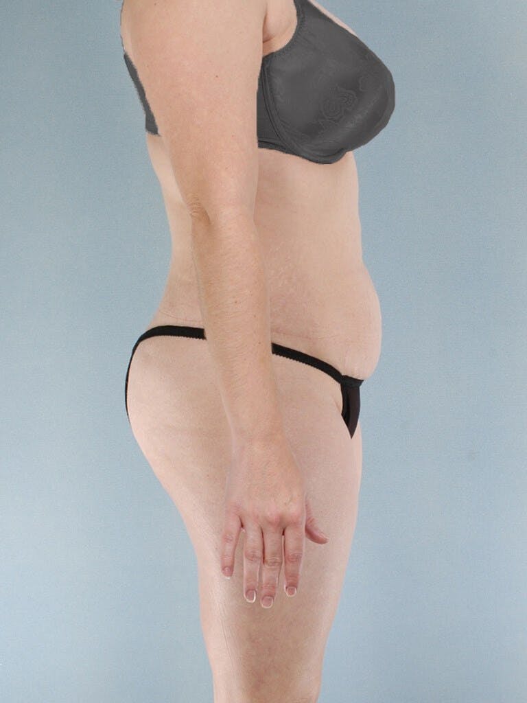 Tummy Tuck Before & After Gallery - Patient 263289 - Image 5