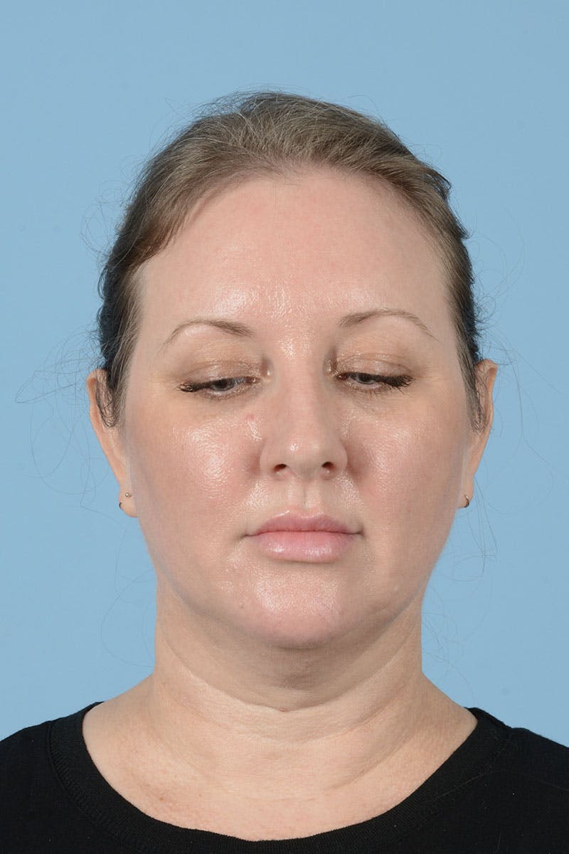 Facelift Before & After Gallery - Patient 443008 - Image 3