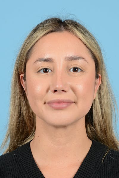 Rhinoplasty Before & After Gallery - Patient 189231 - Image 2
