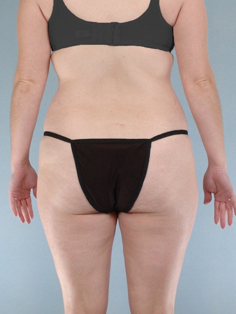 Tummy Tuck Before & After Gallery - Patient 263289 - Image 7