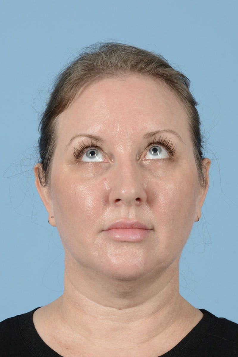 Facelift Before & After Gallery - Patient 443008 - Image 5