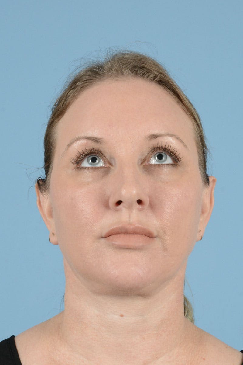 Facelift Before & After Gallery - Patient 443008 - Image 6
