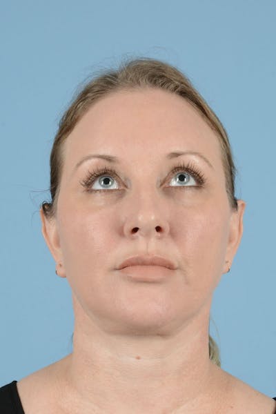 Facelift Before & After Gallery - Patient 443008 - Image 6
