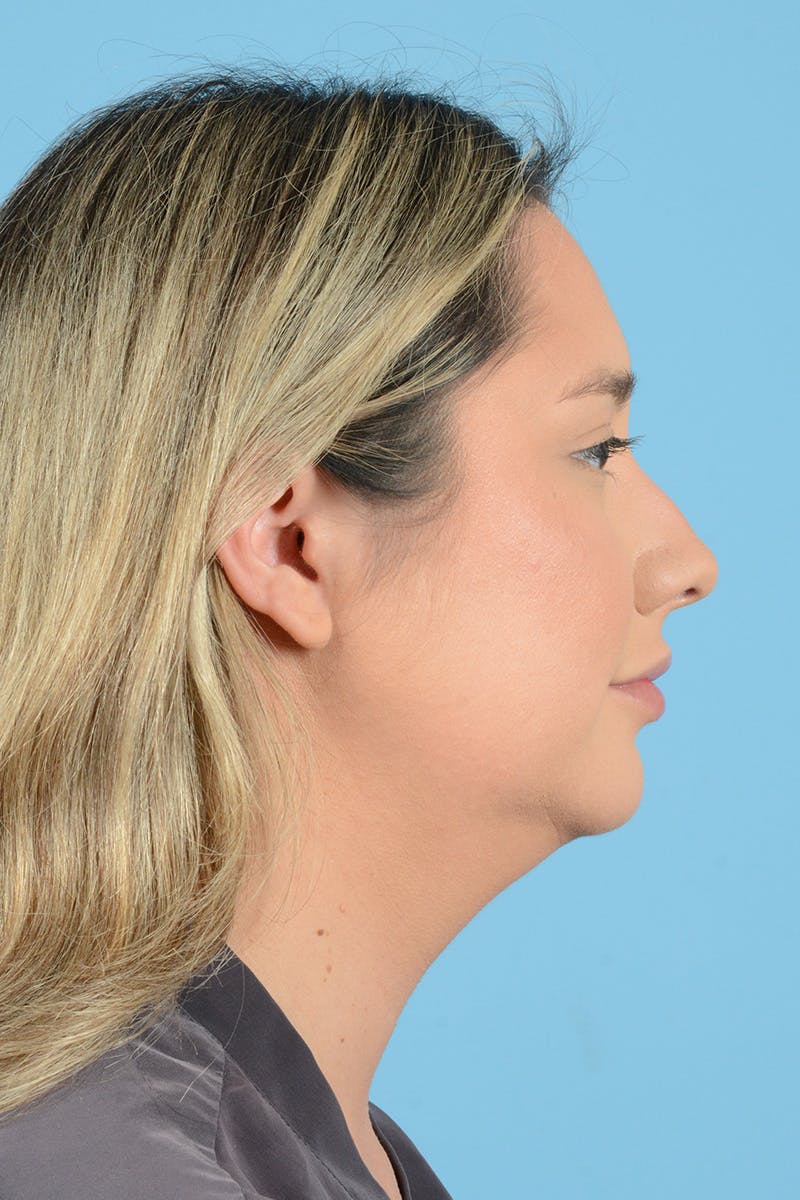 Rhinoplasty Before & After Gallery - Patient 189231 - Image 5