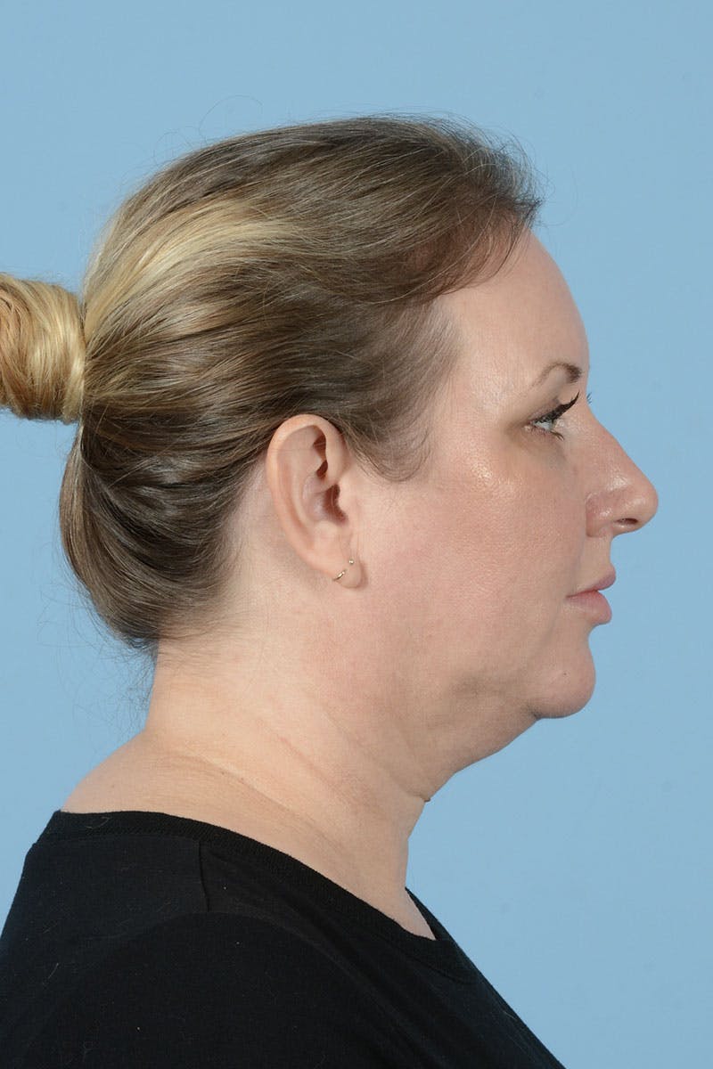 Facelift Before & After Gallery - Patient 443008 - Image 7