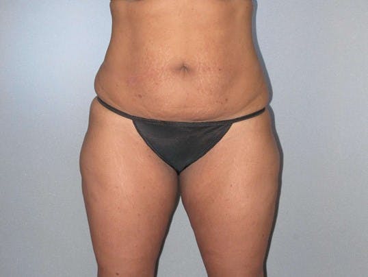 Tummy Tuck Before & After Gallery - Patient 323700 - Image 1