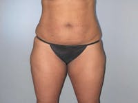 Tummy Tuck Before & After Gallery - Patient 323700 - Image 1