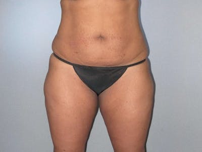 Tummy Tuck Before & After Gallery - Patient 323700 - Image 1