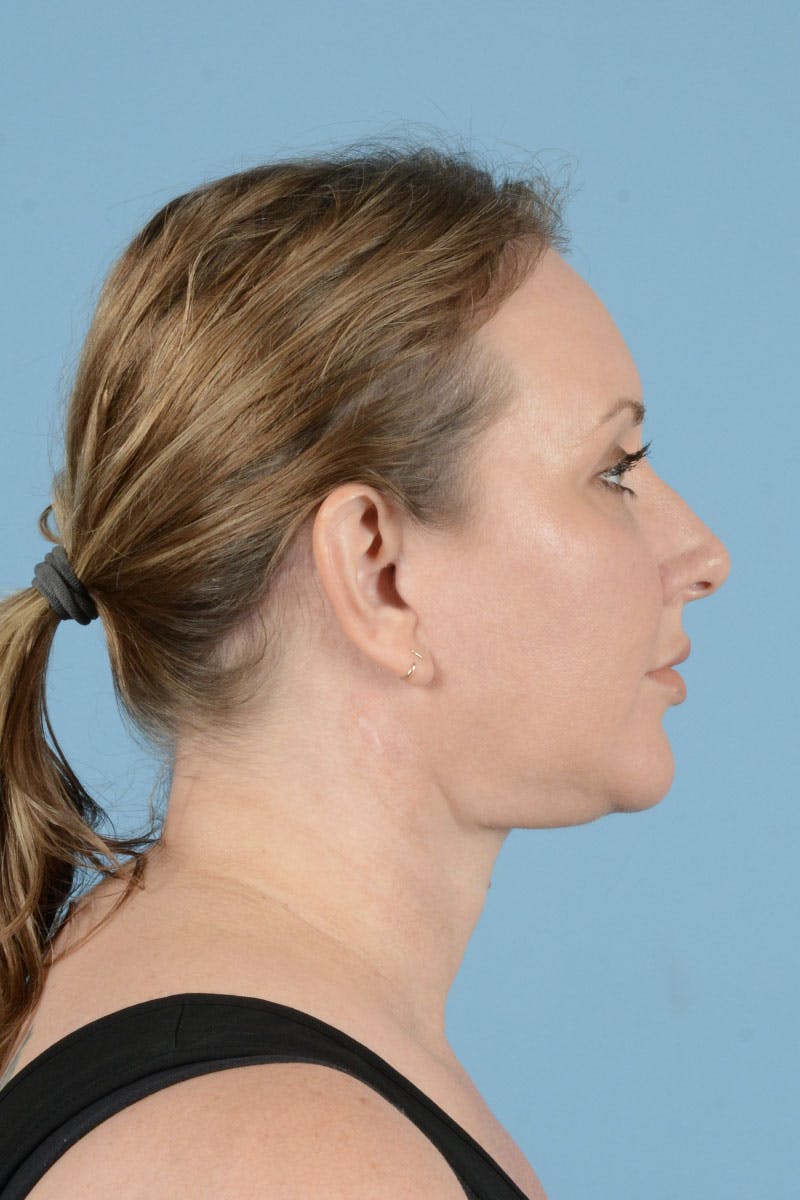Facelift Before & After Gallery - Patient 443008 - Image 8