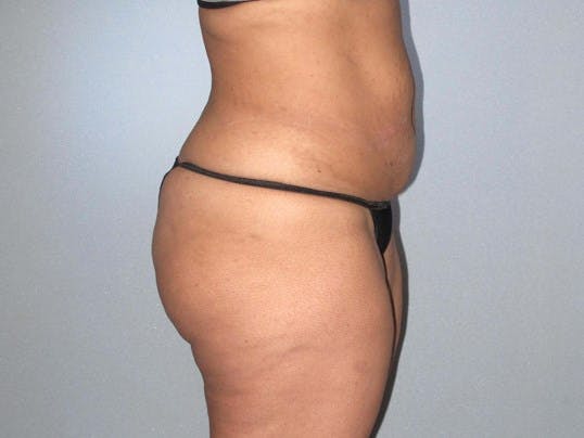 Tummy Tuck Before & After Gallery - Patient 323700 - Image 3