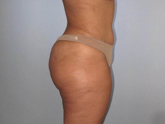Tummy Tuck Before & After Gallery - Patient 323700 - Image 4
