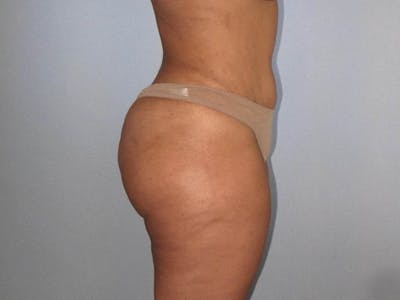 Tummy Tuck Before & After Gallery - Patient 323700 - Image 4