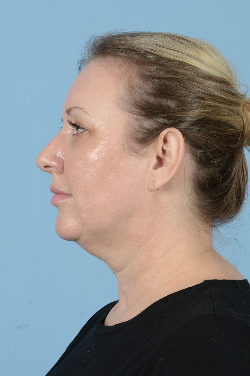 Facelift Before & After Gallery - Patient 443008 - Image 11