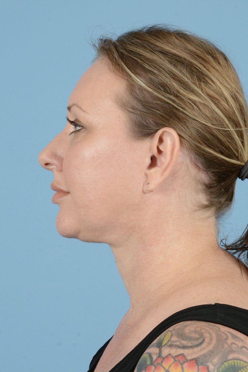 Facelift Before & After Gallery - Patient 443008 - Image 12