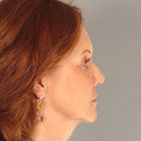 Neck Lift Before & After Gallery - Patient 126886 - Image 1