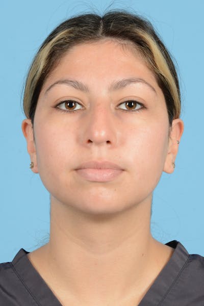 Rhinoplasty Before & After Gallery - Patient 205291 - Image 1