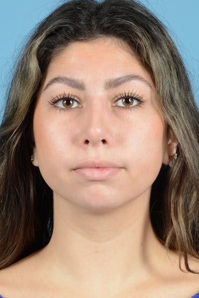 Rhinoplasty Before & After Gallery - Patient 205291 - Image 2
