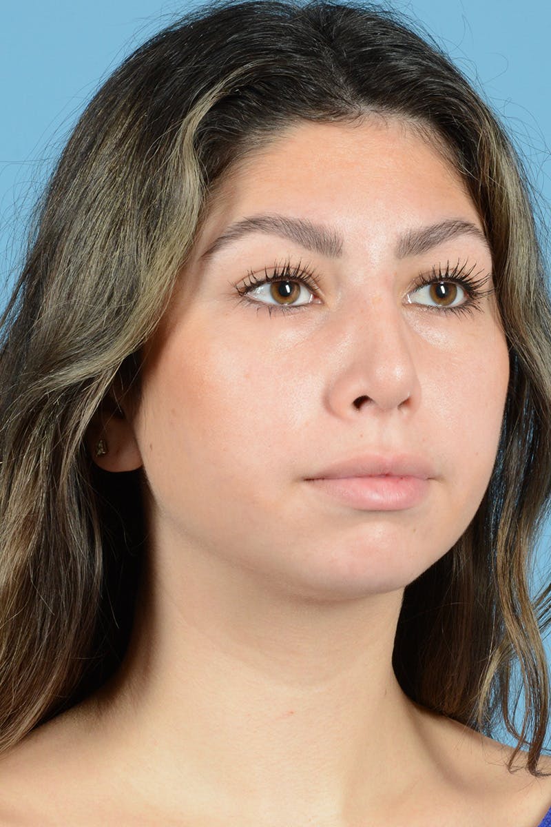 Rhinoplasty Before & After Gallery - Patient 205291 - Image 4
