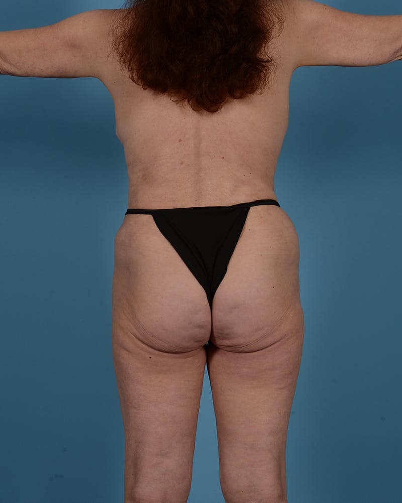 Tummy Tuck Before & After Gallery - Patient 691667 - Image 8