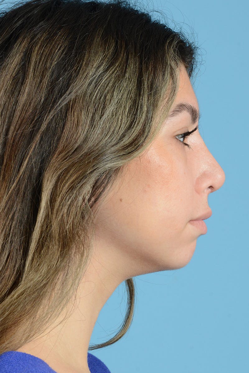 Rhinoplasty Before & After Gallery - Patient 205291 - Image 6