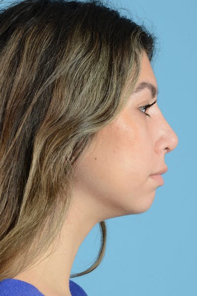 Rhinoplasty Before & After Gallery - Patient 205291 - Image 6