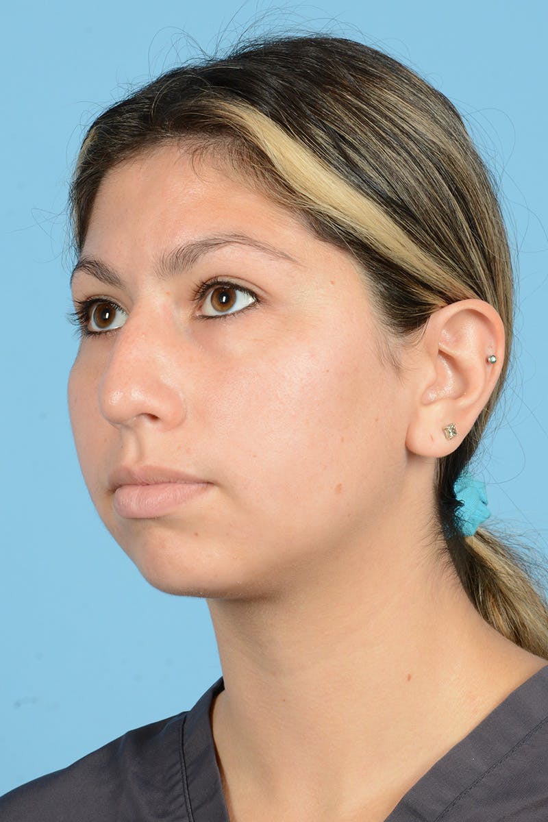 Rhinoplasty Before & After Gallery - Patient 205291 - Image 7