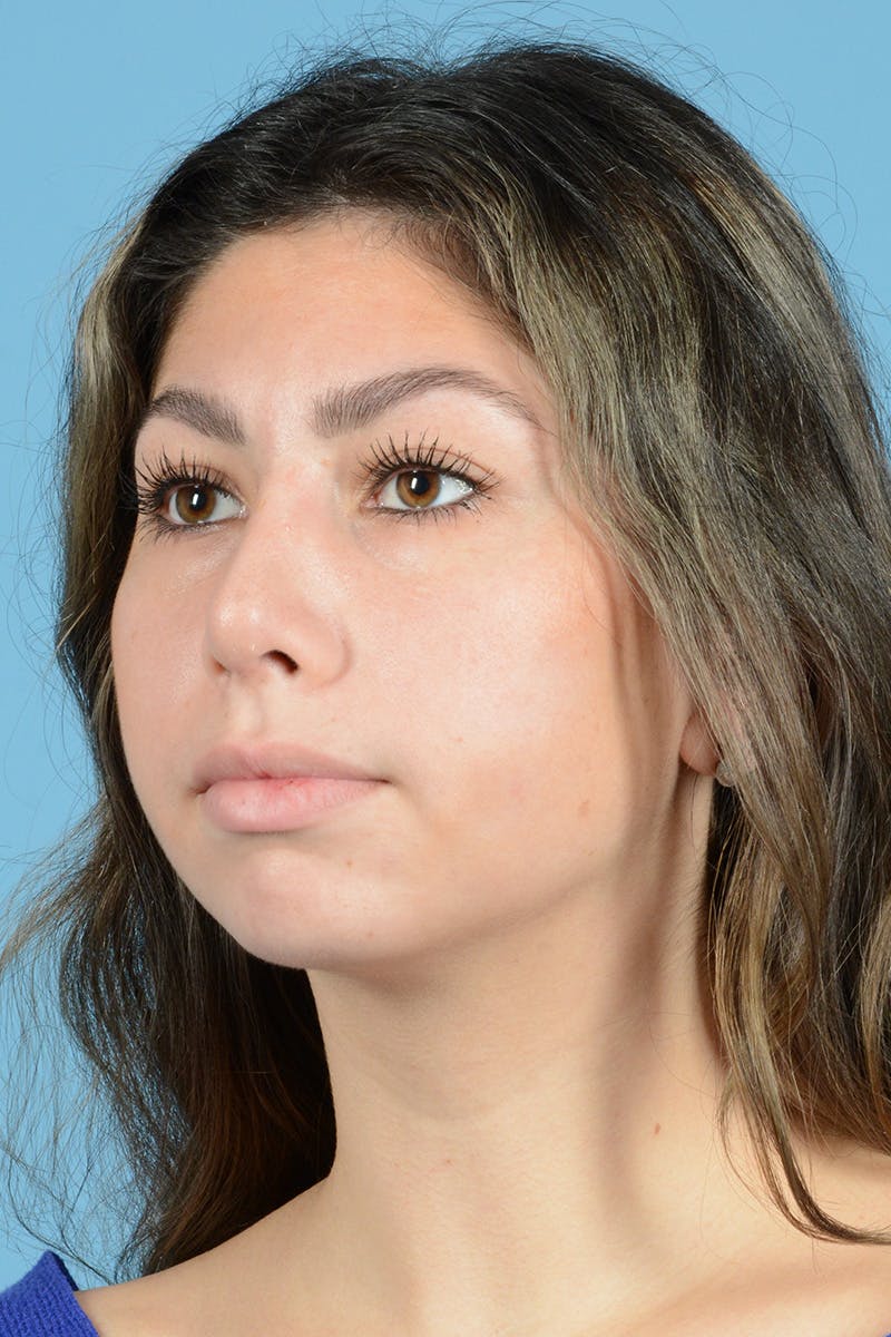 Rhinoplasty Before & After Gallery - Patient 205291 - Image 8