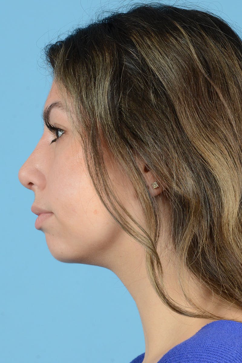 Rhinoplasty Before & After Gallery - Patient 205291 - Image 10