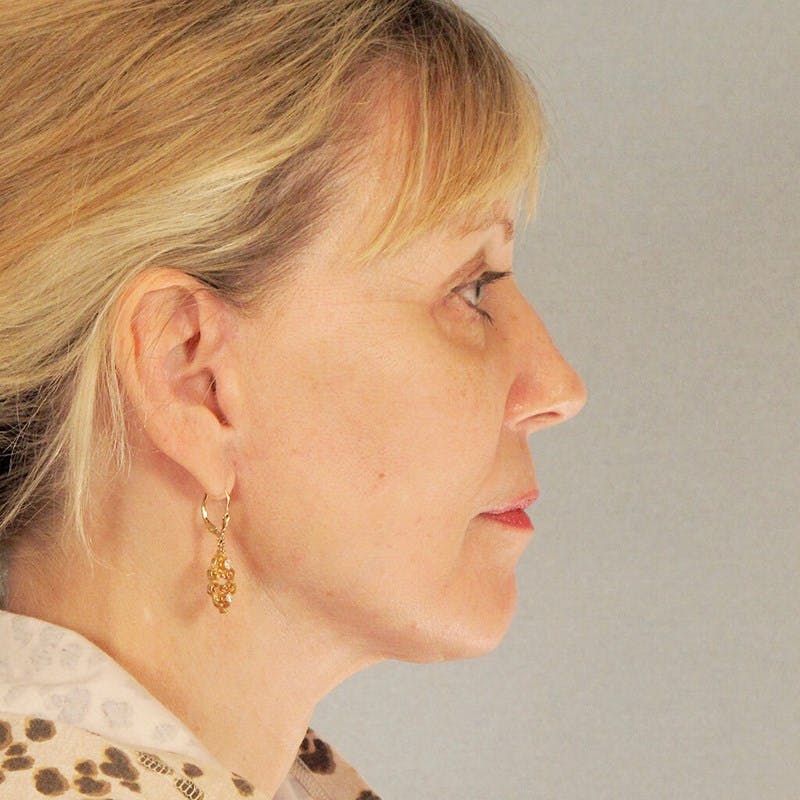 Neck Lift Before & After Gallery - Patient 469141 - Image 2