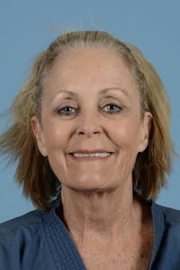 Facelift Before & After Gallery - Patient 177922 - Image 1