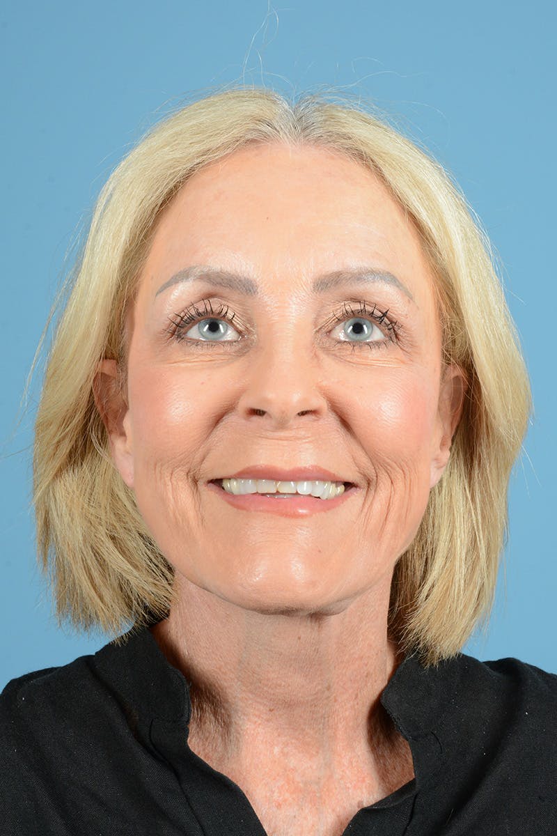 Facelift Before & After Gallery - Patient 177922 - Image 2
