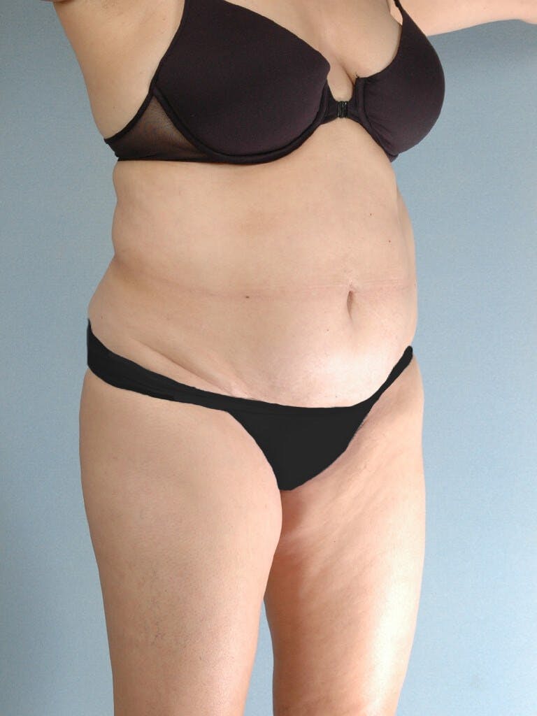 Liposuction Before & After Gallery - Patient 574425 - Image 3