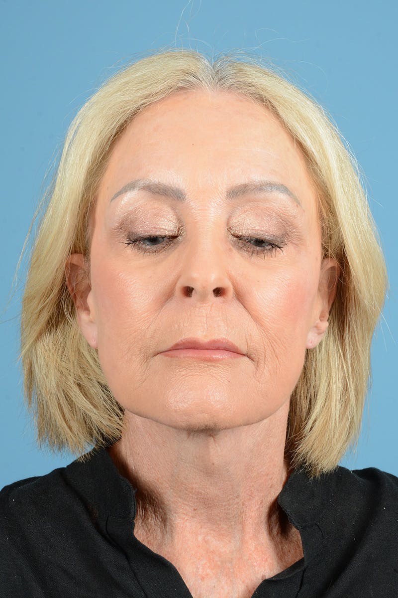 Facelift Before & After Gallery - Patient 177922 - Image 4