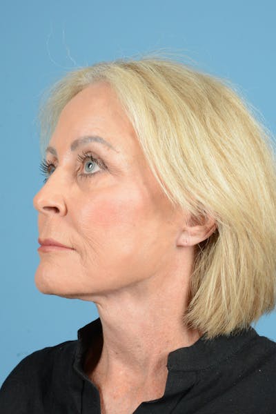 Facelift Before & After Gallery - Patient 177922 - Image 8