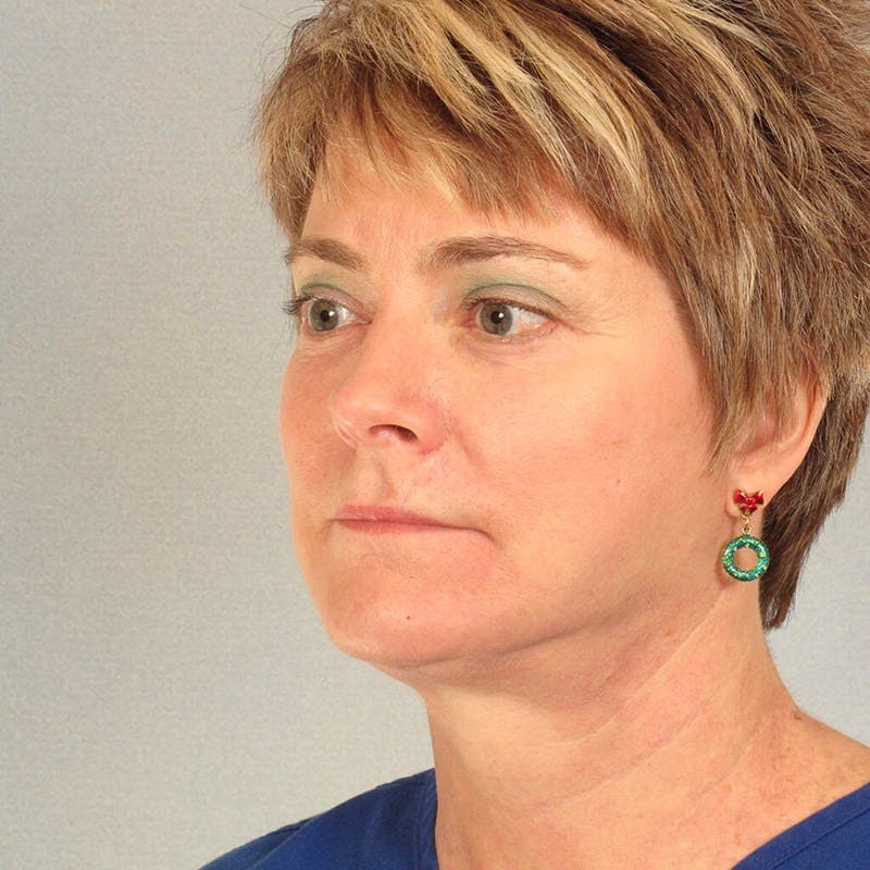 Neck Lift Before & After Gallery - Patient 215212 - Image 4