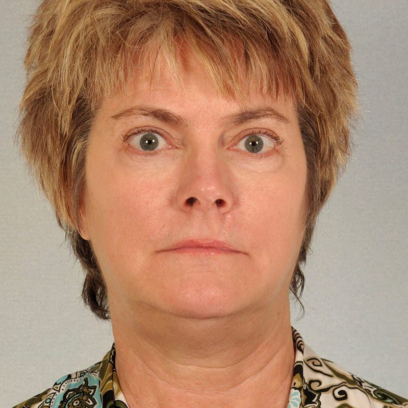 Neck Lift Before & After Gallery - Patient 215212 - Image 5