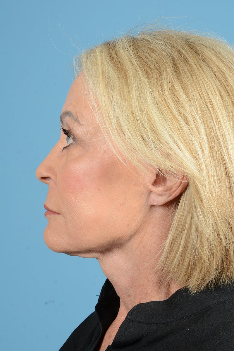 Facelift Before & After Gallery - Patient 177922 - Image 10