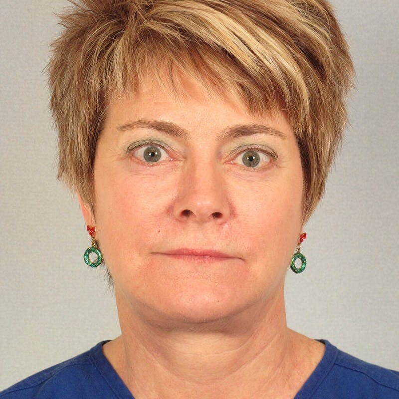 Neck Lift Before & After Gallery - Patient 215212 - Image 6
