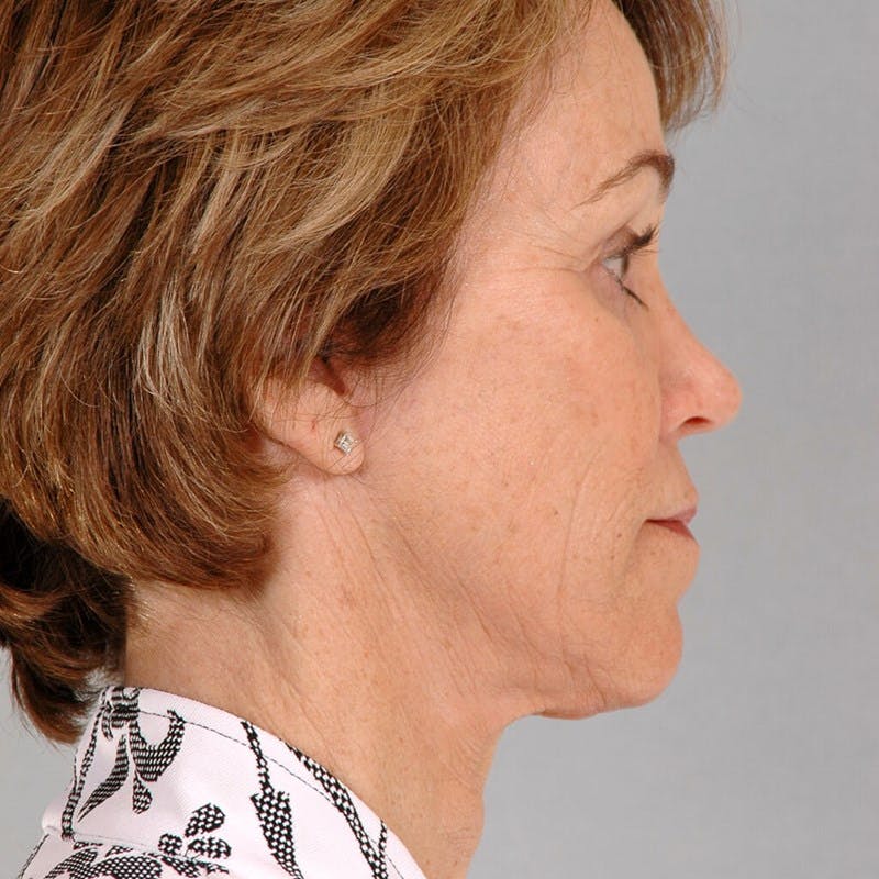 Neck Lift Before & After Gallery - Patient 427514 - Image 2