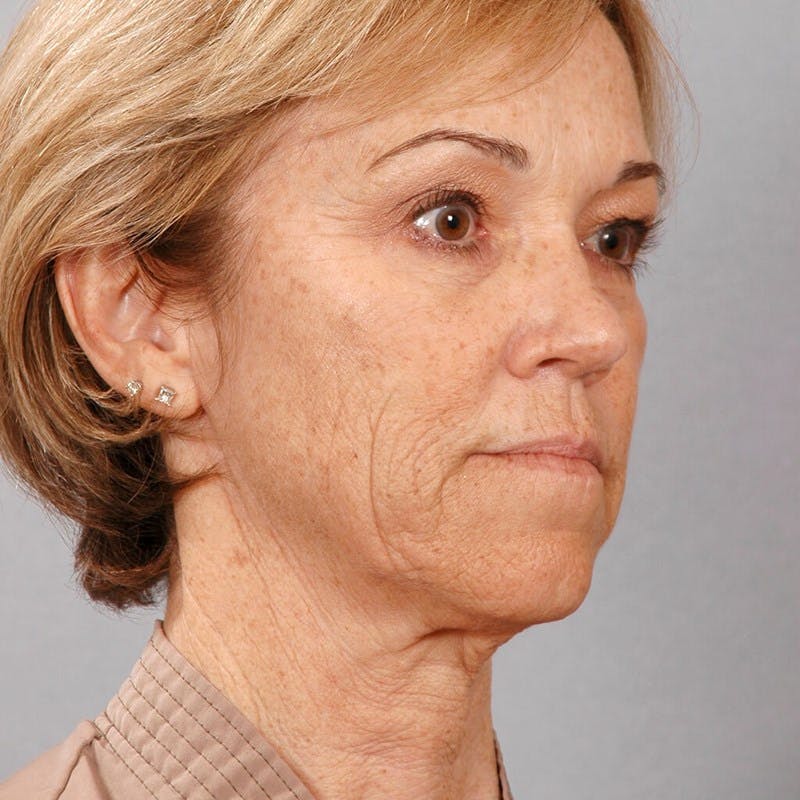 Neck Lift Before & After Gallery - Patient 427514 - Image 3