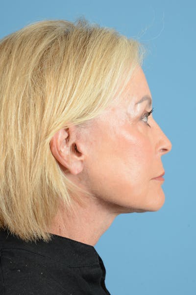 Facelift Before & After Gallery - Patient 177922 - Image 14
