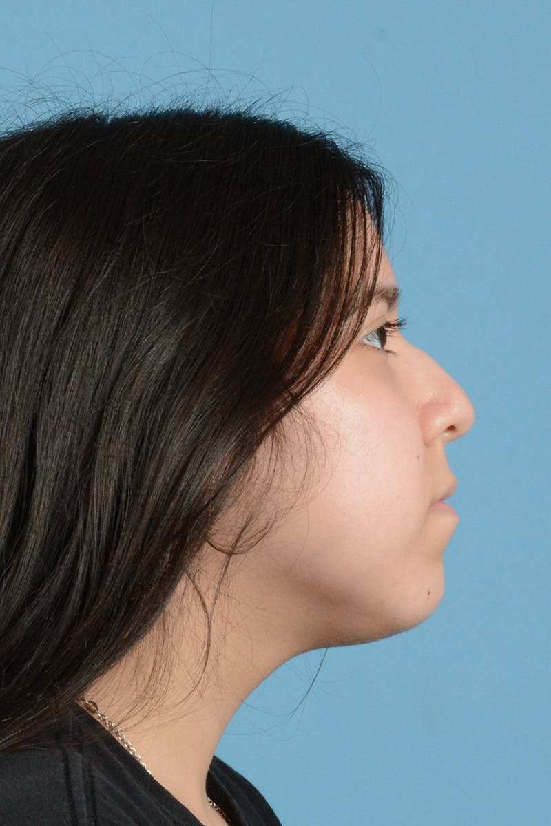 Rhinoplasty Before & After Gallery - Patient 244027 - Image 5