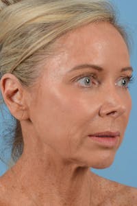 Facelift Before & After Gallery - Patient 218505 - Image 1