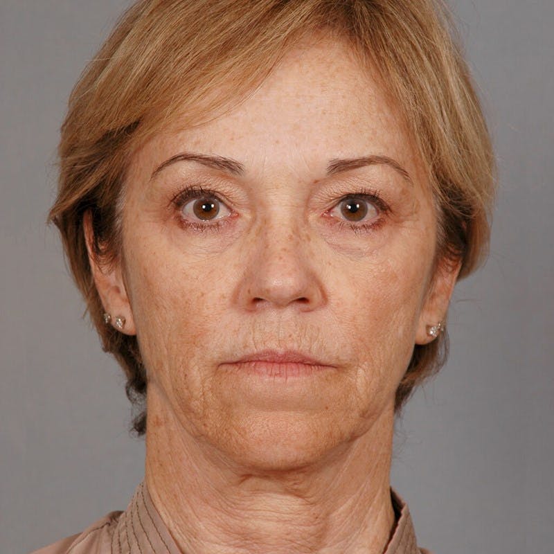 Neck Lift Before & After Gallery - Patient 427514 - Image 5