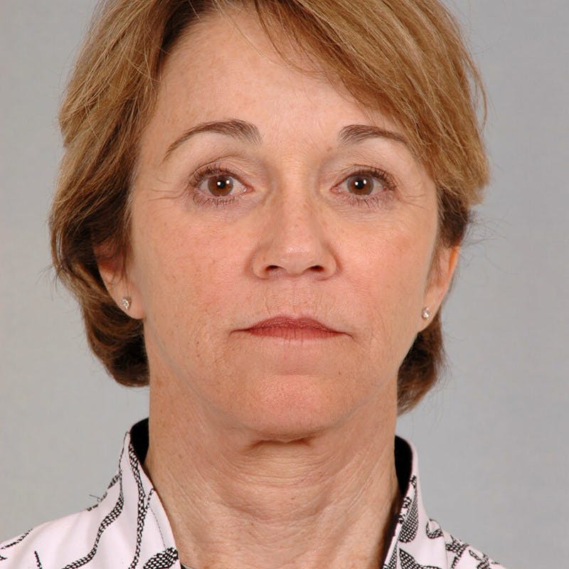 Neck Lift Before & After Gallery - Patient 427514 - Image 6
