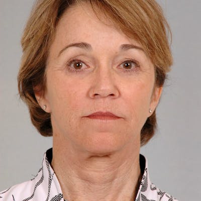 Neck Lift Before & After Gallery - Patient 427514 - Image 6